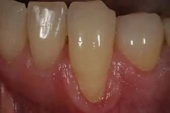 Gum graft before