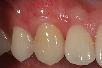 Gum Graft 2 after