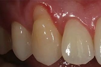 Gum Graft 2 before
