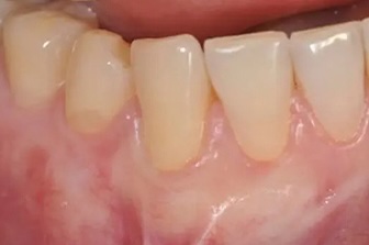 Gum Graft 3 after