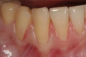 Gum Graft 3 before