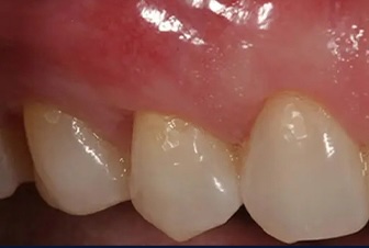 Gum Graft 4 after