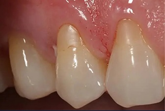 Gum Graft 4 before