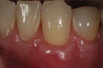 Gum graft after