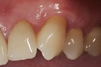Gum Rejuvenation 1 after