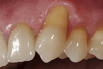 Gum Rejuvenation 1 before