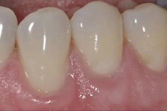 Gum Rejuvenation 2 after