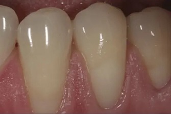 Gum Rejuvenation 2 before