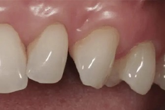 Gum Rejuvenation 3 after