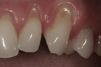 Gum Rejuvenation 3 before