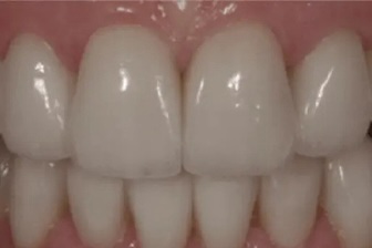 Smile Makeover 1 after
