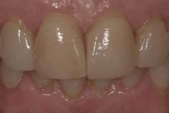 Smile Makeover 1 before