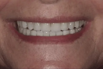 Smile Makeover 2 after