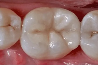 White Filling after
