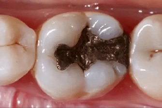 White Filling before