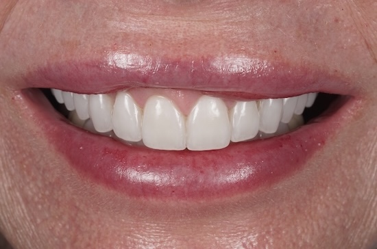 Veneers after