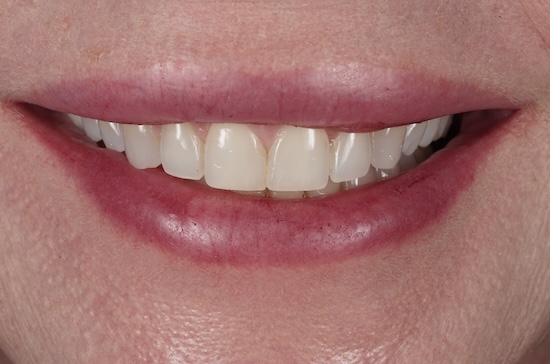 Veneers before