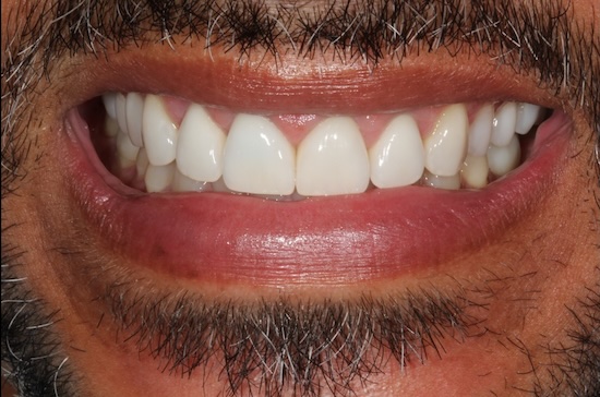 Smile Makeover after
