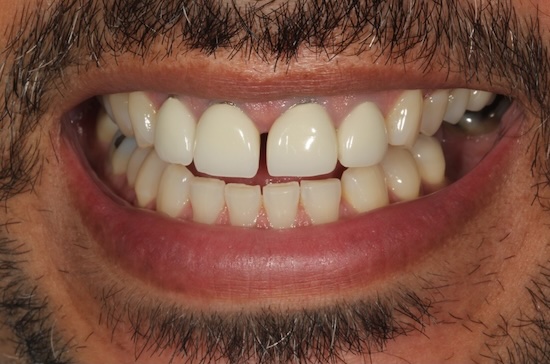 Smile Makeover before