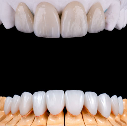 Cost of Veneers
