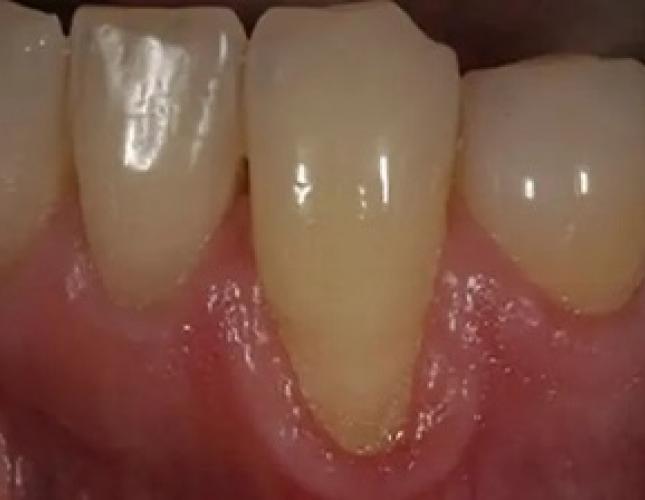 Gum graft before
