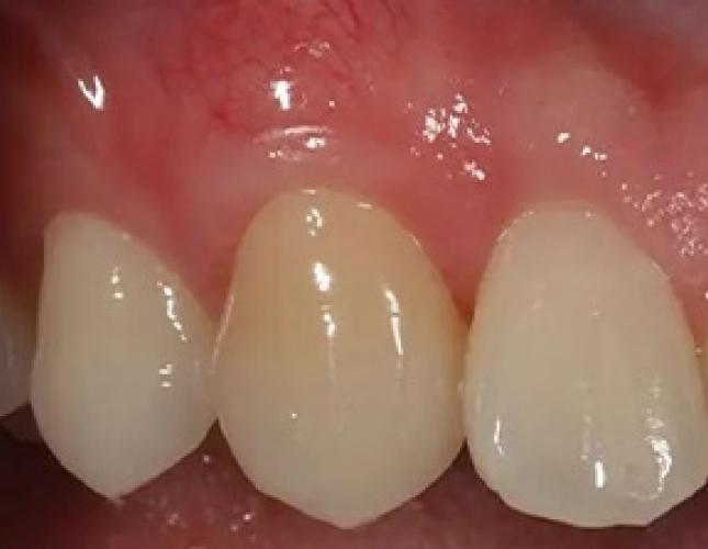 Gum Graft 2 after