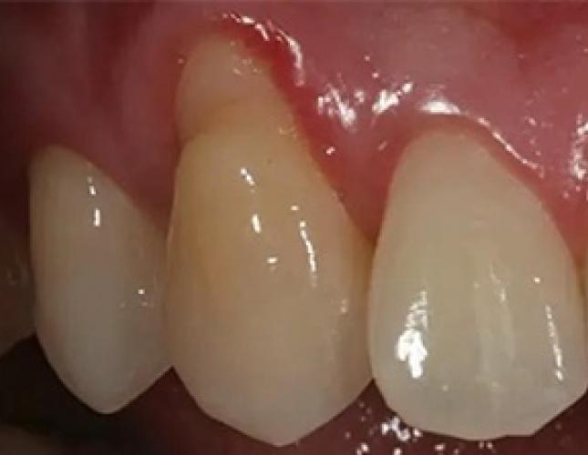 Gum Graft 2 before