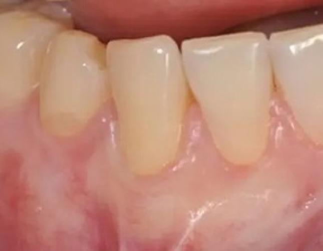 Gum Graft 3 after