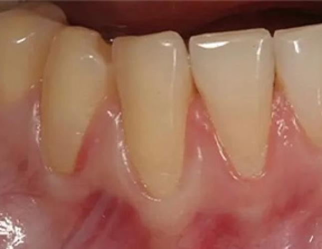 Gum Graft 3 before