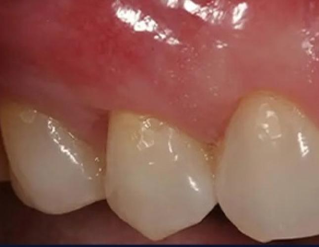 Gum Graft 4 after