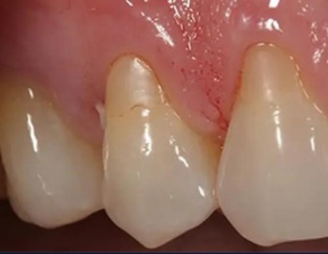 Gum Graft 4 before