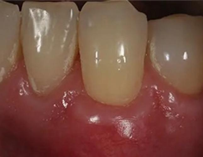 Gum graft after