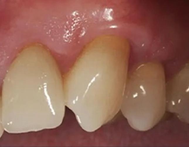 Gum Rejuvenation 1 after