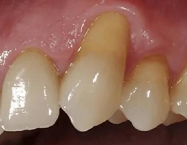 Gum Rejuvenation 1 before