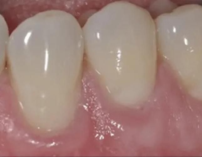 Gum Rejuvenation 2 after