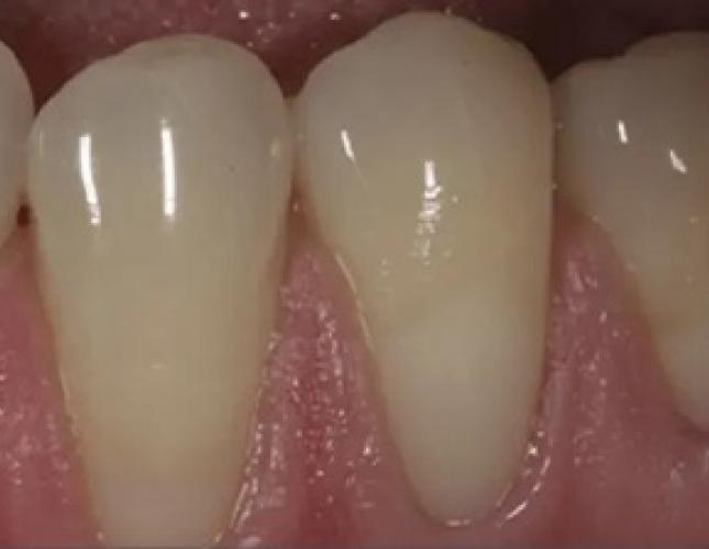 Gum Rejuvenation 2 before