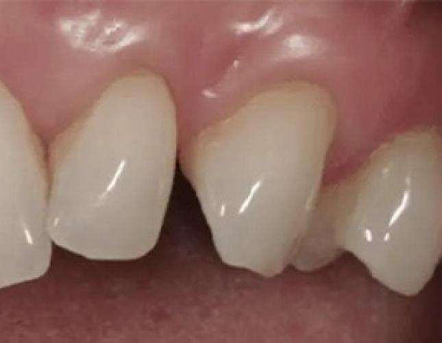 Gum Rejuvenation 3 after