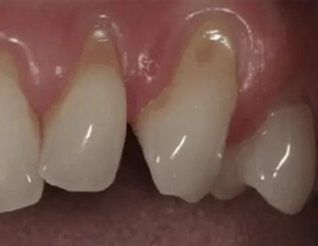 Gum Rejuvenation 3 before
