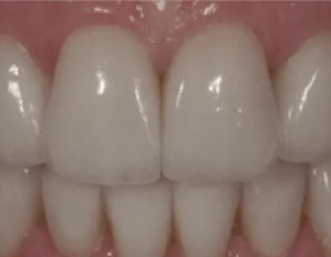 Smile Makeover 1 after