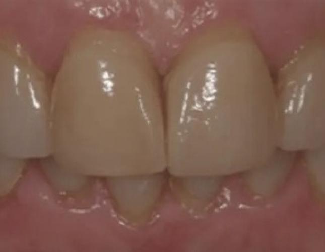 Smile Makeover 1 before