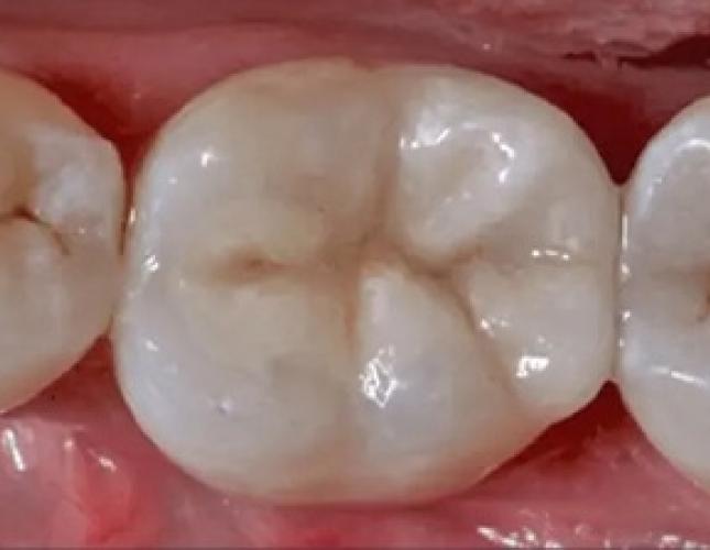 White Filling after