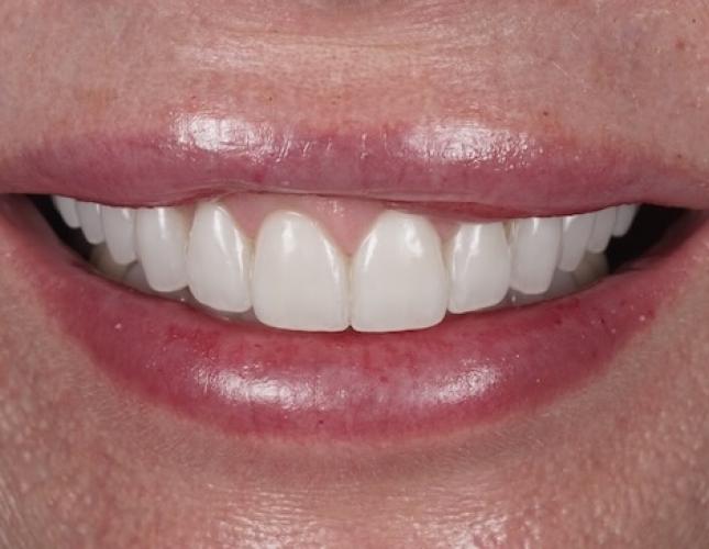 Veneers after