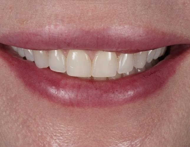 Veneers before