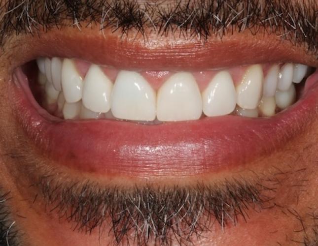 Smile Makeover after
