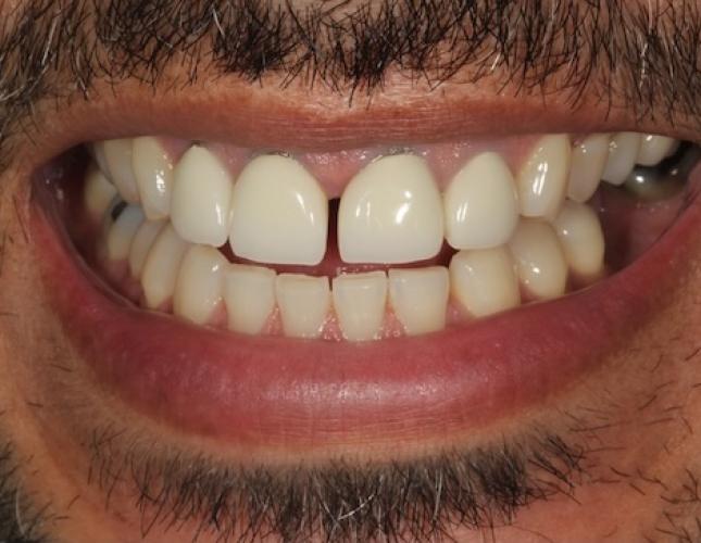 Smile Makeover before