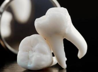 What Is a Deep Dental Cleaning? Understanding Scaling and Root Planing