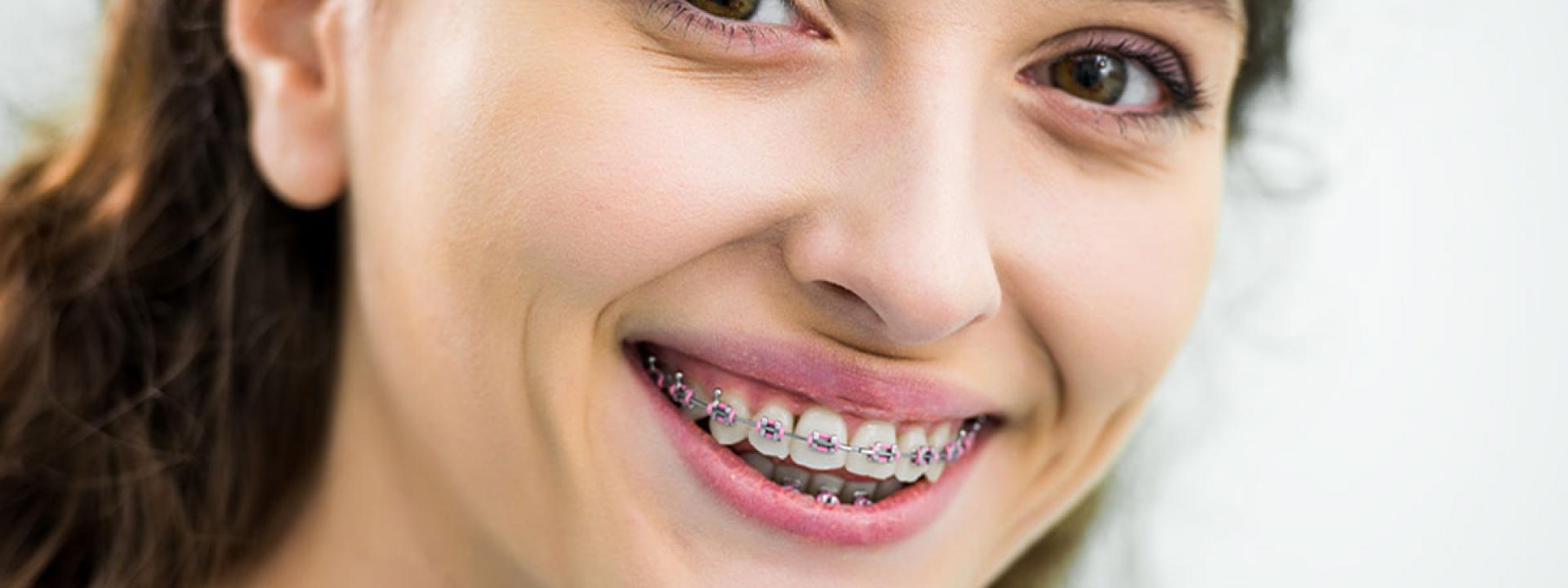 Braces