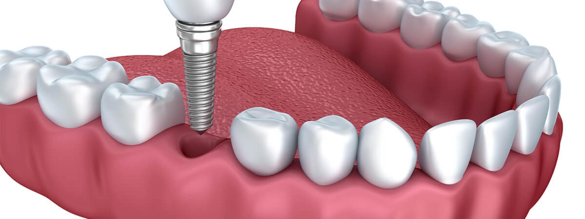 Cosmetic Tooth Replacement in Beverly Hills CA Area