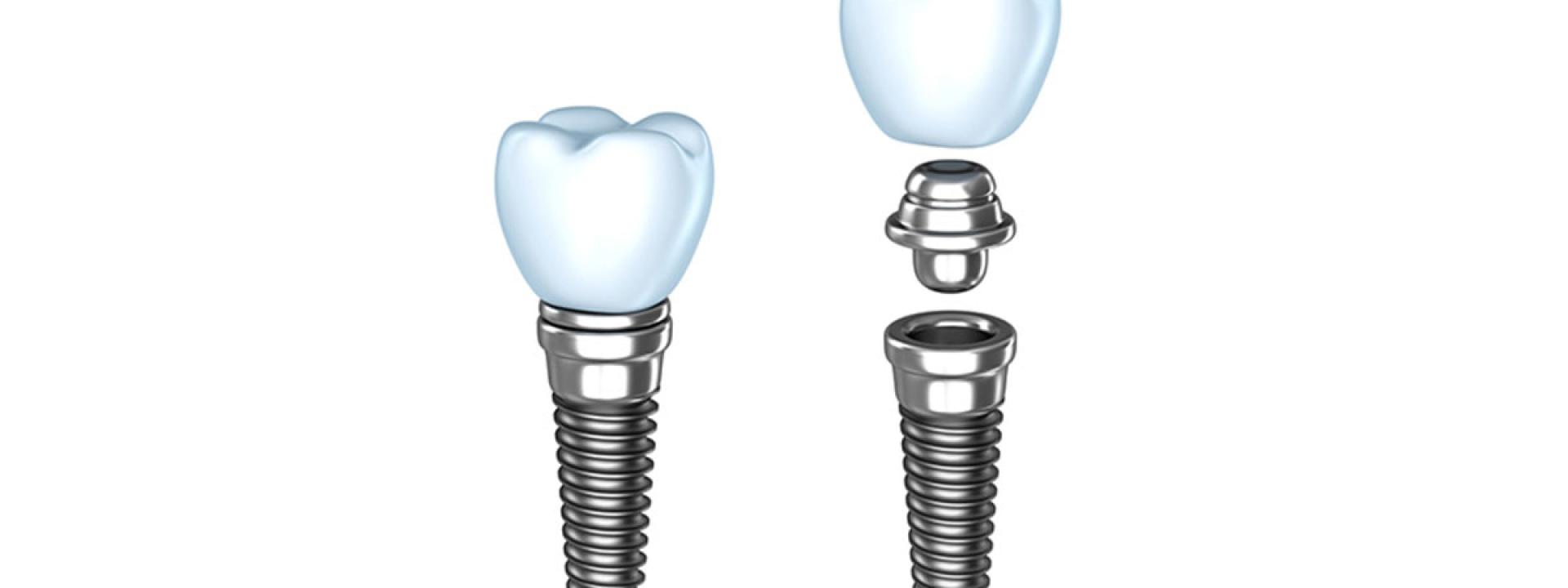 Dental implants