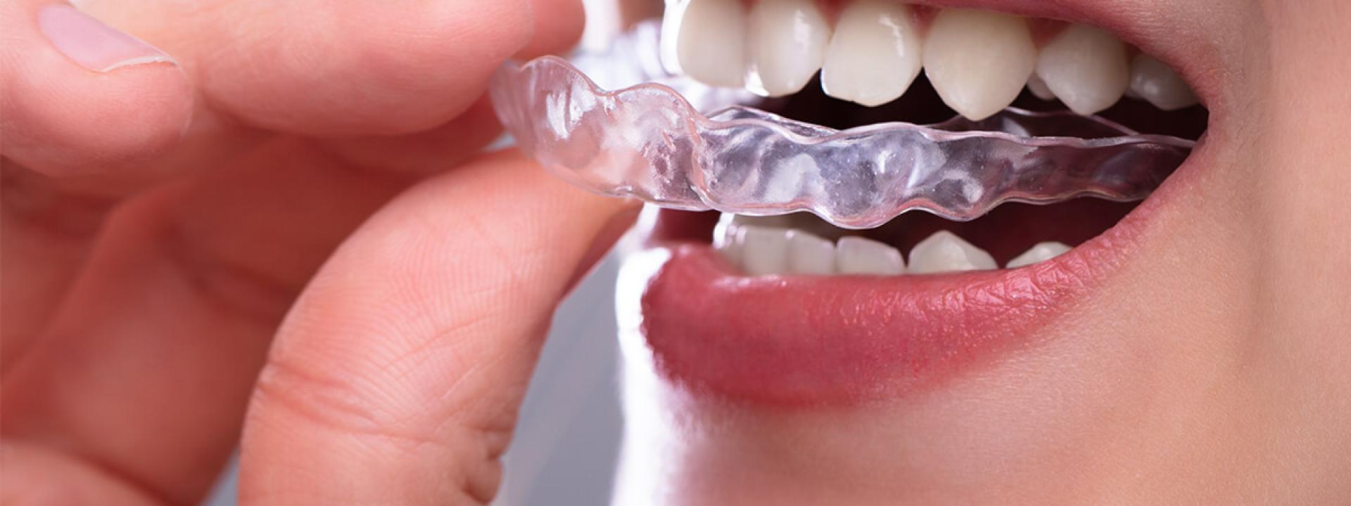 Invisalign Clear Aligners in Beverly Hills CA Area
